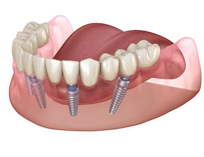 all on 4 dental implants west allis