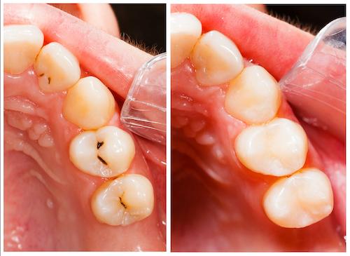 tooth filling west allis | before and after photo